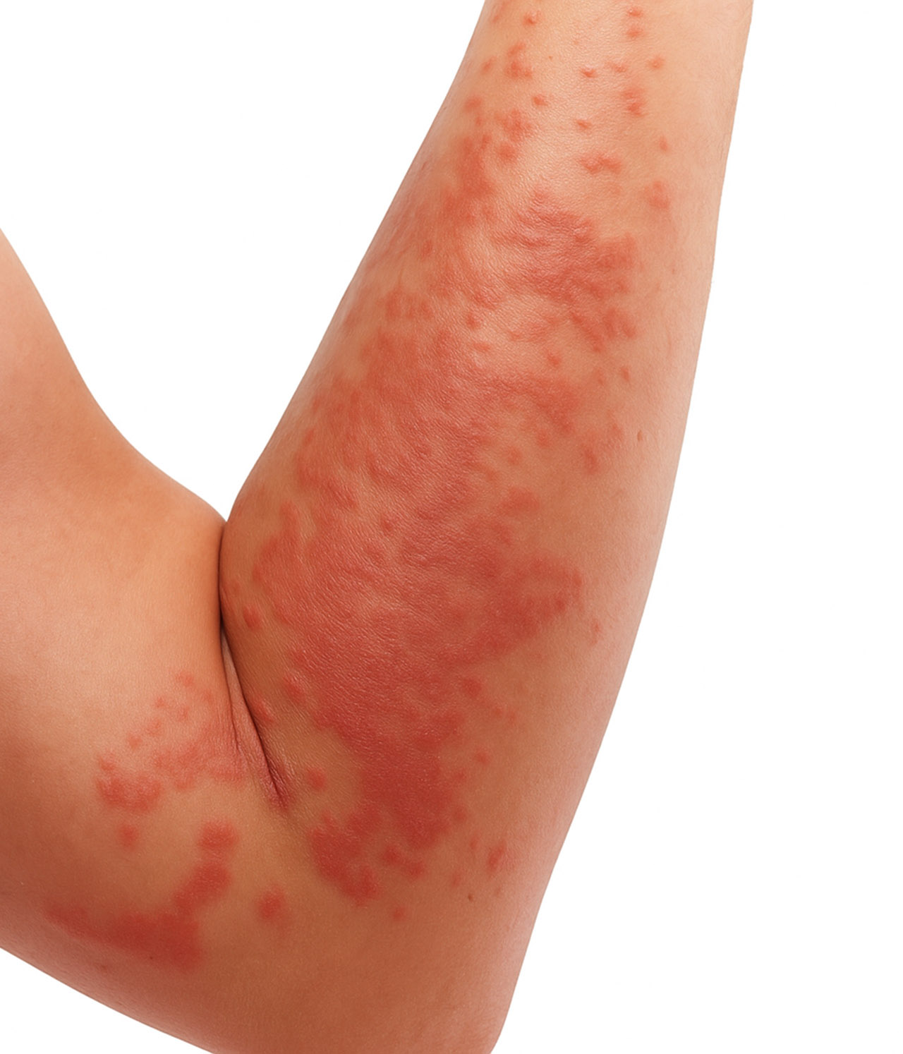 Chronic Skin Allergy