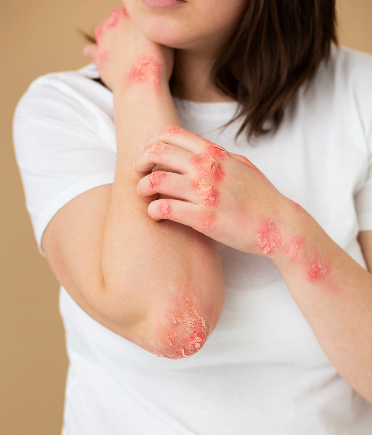 Allergic Contact