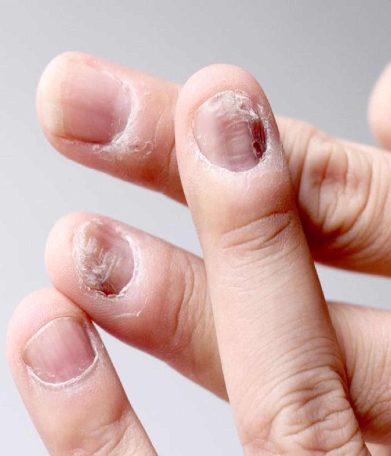 Nails Disorder